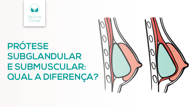 Prótese subglandular e submuscular: qual a diferença?