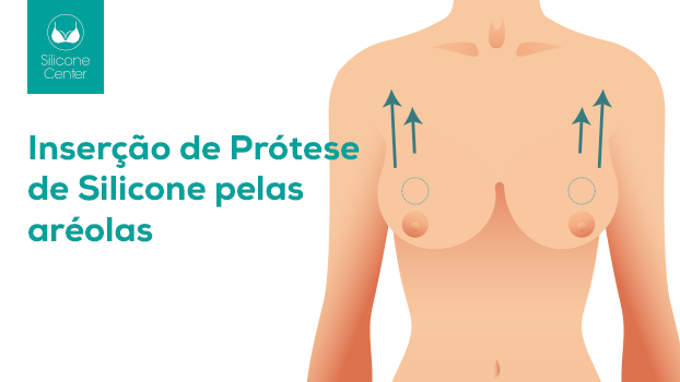 Mamoplastia de aumento pela aréola: quando é indicada?