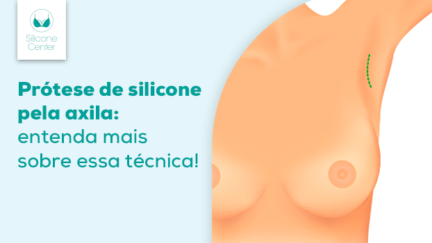 Prótese de silicone pela axila: existe alguma vantagem?
