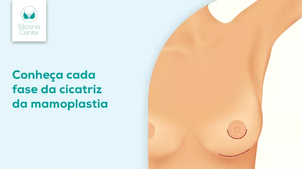 Conheça cada fase da cicatriz da Mamoplastia
