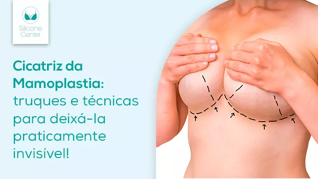 Como deixar a cicatriz da mamoplastia praticamente invisível?